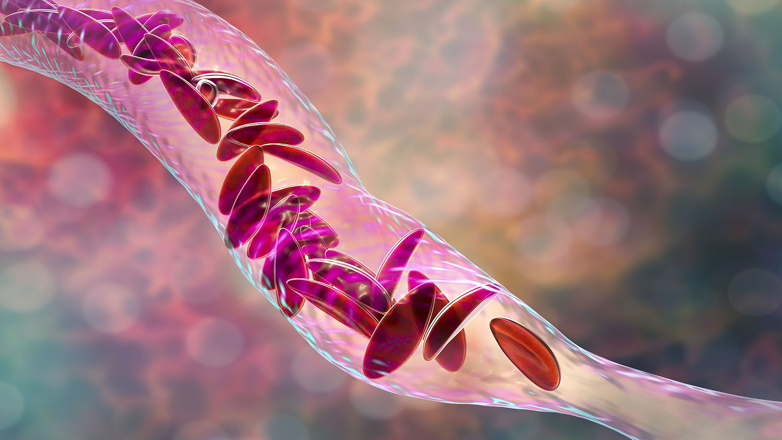 Sickle Cell Disease: A Spotlight on Women